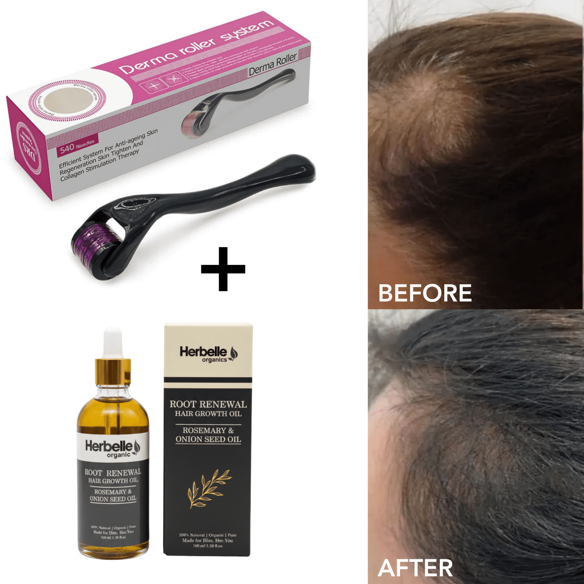 Derma Roller 0.5 mm - Herbelle OraganicsHerbelle Oraganics